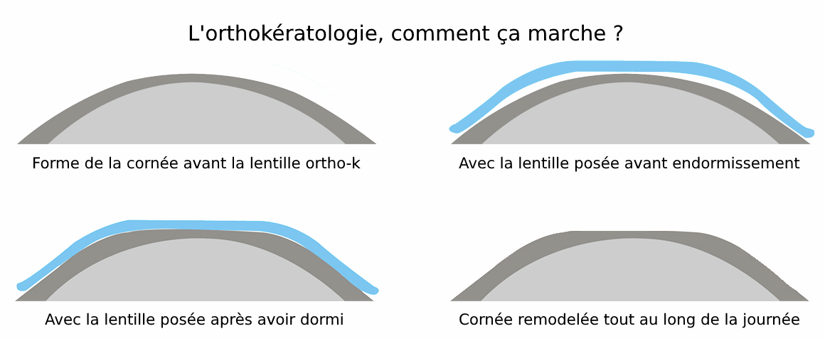 L'orthokératologie