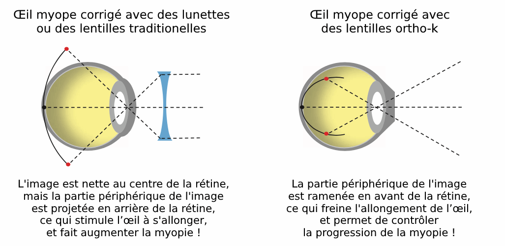 L'ortho-k freine la myopie